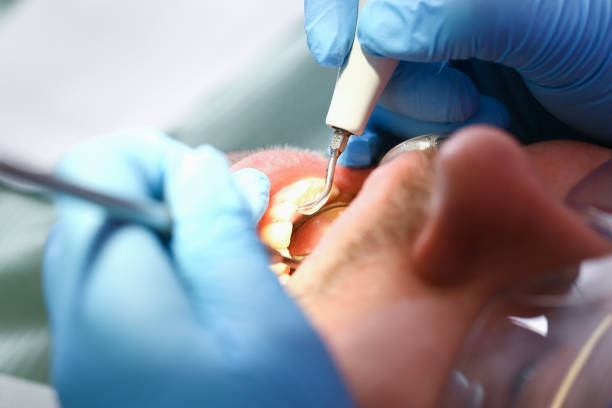 Best Emergency Tooth Extraction in Fussels Corner, FL