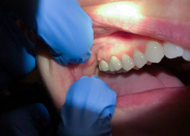 Best Emergency Treatment for Dental Infections or Abscesses in Fussels Corner, FL