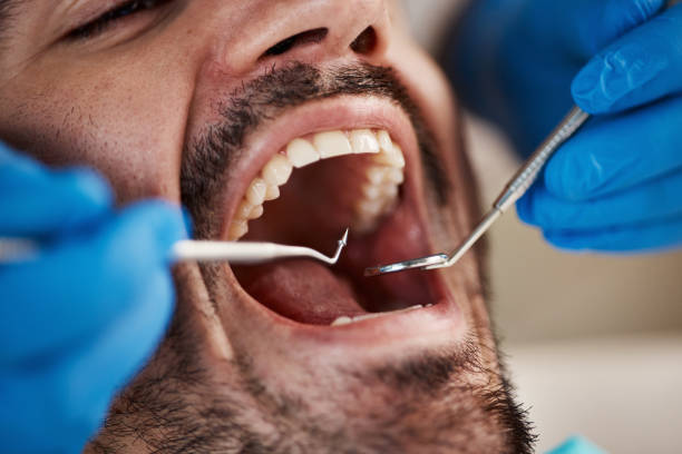 Best Emergency Wisdom Teeth Removal in Fussels Corner, FL
